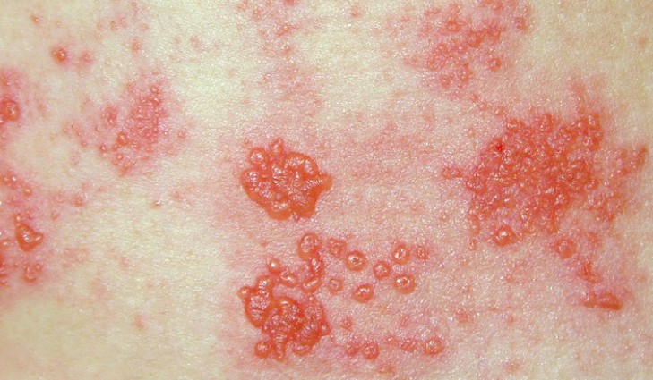 Unique Efficacy of SNAN Acupuncture in Treating Herpes Zoster and Postherpetic Neuralgia