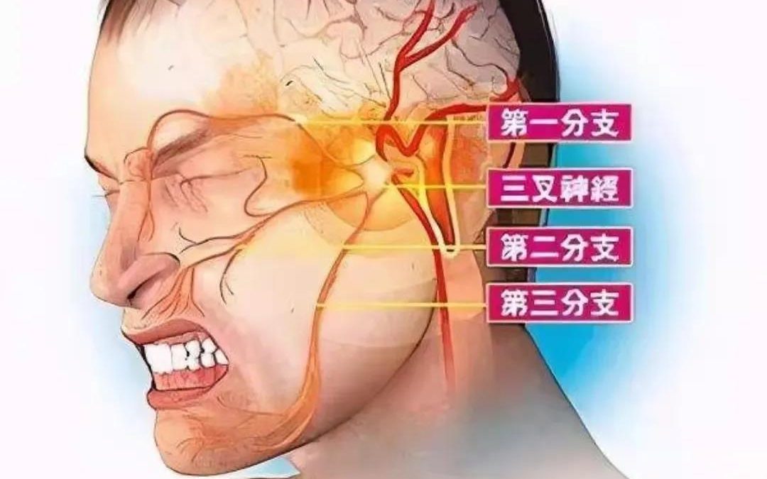 Electric-Shock Facial Pain Near the Nose—Trigeminal Neuralgia Relieved Without Long-Term Medication